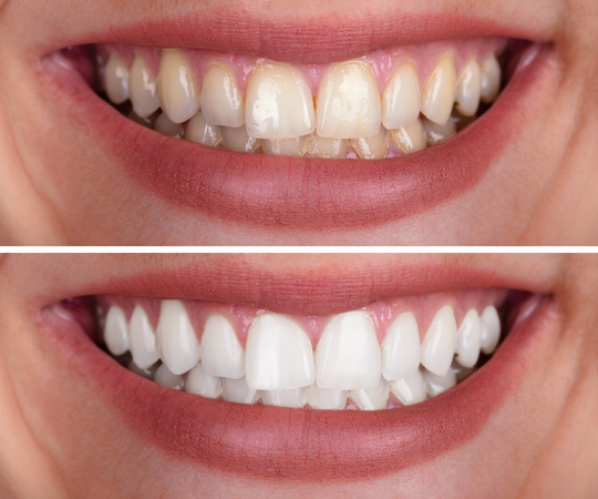 Teeth whitening in lilburn