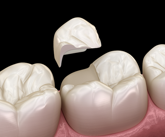 Dental bonding in lilburn