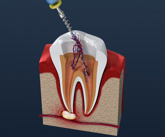 Root canal treatment in lilburn ga