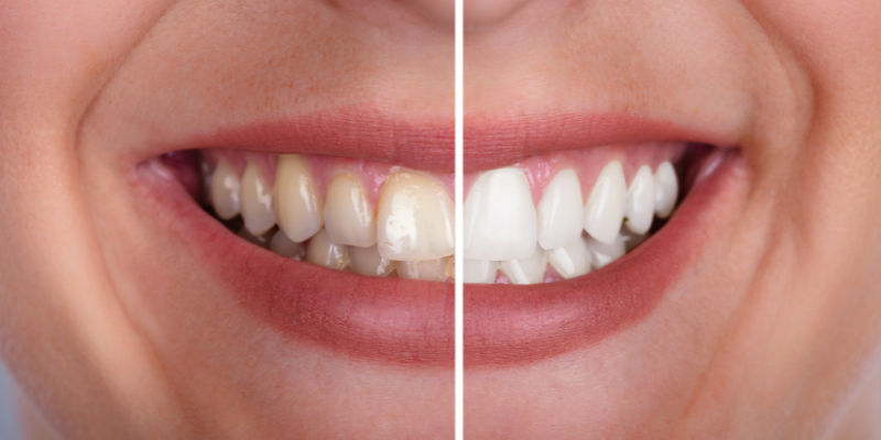 Teeth whitening lilburn ga