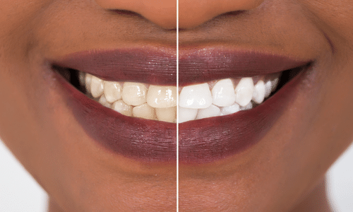 teeth whitening lilburn ga