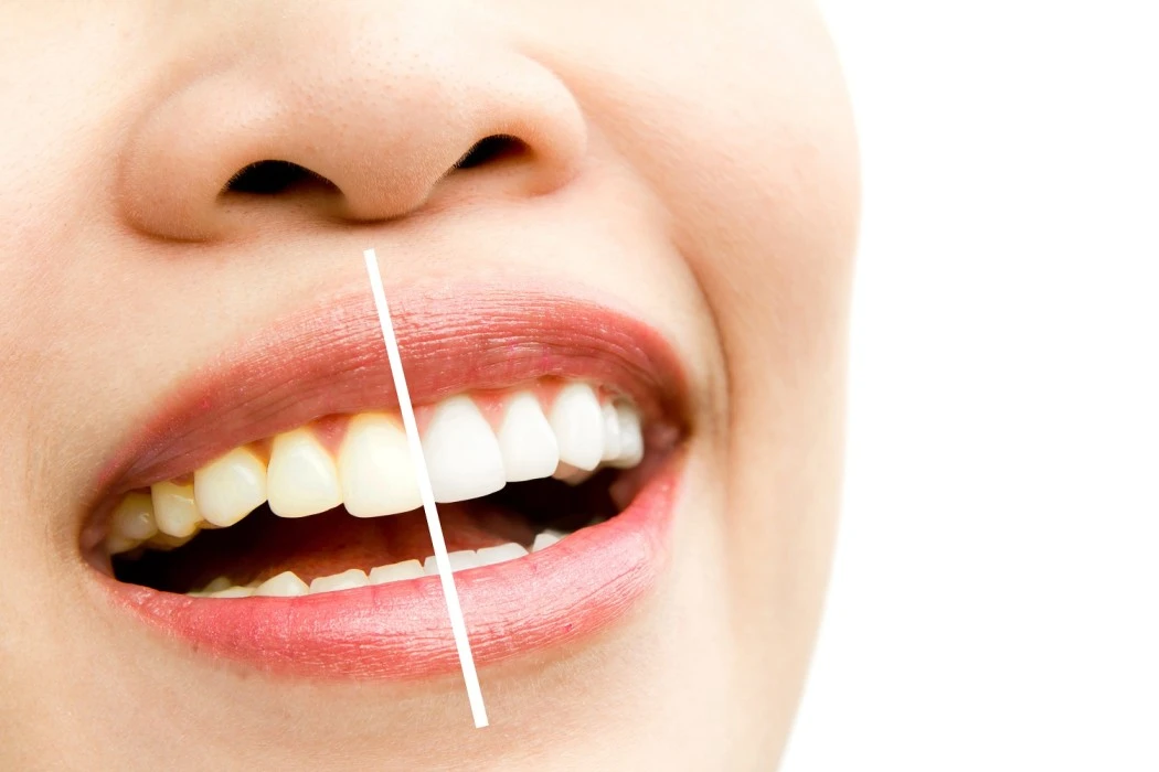 Teeth Bonding vs Veneers Which Smile Solution Is Right for You