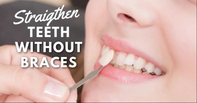 How to Straighten Teeth Without Brace
